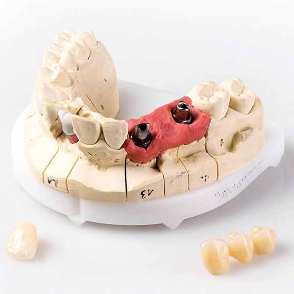 runkeldent-implantat-prothetik-9146